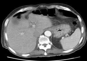 Axial abdominal-pelvic CT scan showing the disappearance of gastric pneumatosis, free fluid and bubbles of ectopic gas and portal venous gas.