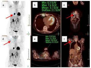 Total-body PET/CT: (a) coronal PET image showing hyperuptake of the internal breast (arrow); (b) axial PET/CT showing the same lesion (circle); (c) coronal PET/CT image with the lesion in white (arrow); (d) coronal PET view with hyperuptake in the right supraclavicular region; (e) axial PET/CT slice demonstrating the same involvement (circle); (f) coronal PET/CT showing right cervical hyperuptake in white (arrow).