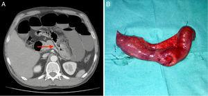 Abdominal CT scan demonstrating the point of obstruction (A) and the surgical piece (B).