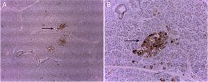 Images of immunohistochemistry with chromogranin: the neuroendocrine cells of the islets of Langerhans are stained brown (right image at higher magnification, 40×).