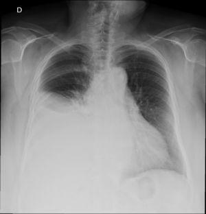 Simple chest radiograph showing right hydrothorax.
