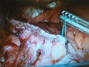 Intraoperative image: sutures from the previous POSE appearing through the staple line.