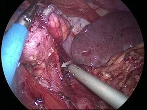 Maintained vascularization irrigating the small gastric stump.