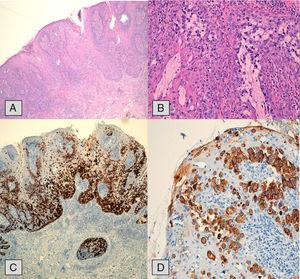 (A) Extension study with hematoxylin–eosin stain showing infiltration and hyperplasia of the epidermal layer; (B) pagetoid cells are observed with ample cytoplasm and atypical nucleus with less prominent nucleoli; (C and D) immunohistochemistry study with cytokeratin 7 (CK7) demonstrating cytoplasmic positivity in the Paget cells, at basal layers and ascending.
