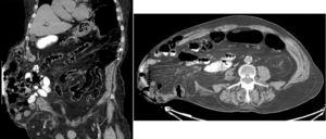 Lumbar incisional hernia: CT image.