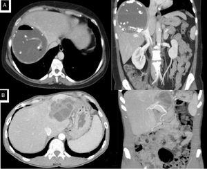 (A) Case 1: abdominal CT scan showing a hydatid cyst measuring 11.5cm in segment VII–VIII that communicates with the bile duct; (B) Case 2: abdominal CT scan showing a hydatid cyst measuring 6.4cm in the left liver lobe compressing the left intrahepatic bile duct; B: surgical field.