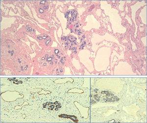 Above, H–E 4×: breast parenchyma with irregular vascular structures of different sizes, some with muscle wall, and containing proteinaceous material in the lumen. Below: the endothelia show positivity for endothelial lymphatic marker D2-40 (10×) (left) and negativity for WT-1 (10×) (right).