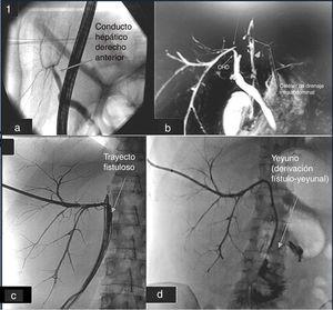a. CPRE preoperative study. It is not realice the CHDP. b. ColangioRMN posthepatectomy, with CHDP, who drained in to the leak. c. Cholangiography showing right posterior duct draining in the intra-abdominal drain with the biliary catheter inside. d. Cholangiography after perform the fistulo-jejunostomy.