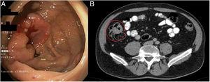 Diagnostic tests: (A) colonoscopy: neoplasm in right colon adjacent to the cecum and ileocecal valve, with histological confirmation of invasive adenocarcinoma; (B) CT scan: mass in the cecum with involvement of the ileocecal valve measuring 7×3.6×3cm, with invasion of the adjacent fat and satellite lymphadenopathies – T3N1M0.