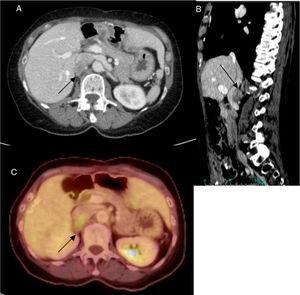 27-mm retroperitoneal nodule from the posterior wall of the inferior vena cava (A and B, arrows); hypermetabolic activity of the nodule on PET/CT (C, arrow).