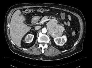 Triple-phase abdominal CT scan showing a large retroperitoneal mass in the area of the left adrenal gland and kidney.