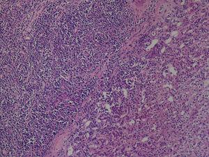 Tumor comprised of monomorphic cells similar to blasts, with centrally located oval nuclei and basophilic cytoplasm (IgG+) (hematoxylin–eosin).