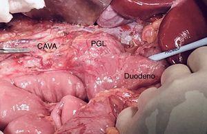 Intraoperative image: after mobilizing the duodenum medially, the paraganglioma (PGL) is observed, a mass below the left renal vein, in intimate contact with the aorta and inferior vena cava (tip of the clamp).