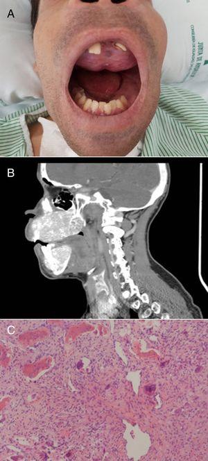 A) Deformity of the maxilla and mandible. Brown tumor on the upper palate. B) CT scan of the skull showing diffuse bone disease characterized by obvious deformity of the upper and lower jaw, demineralization of the axial skeleton, and extensive lytic-appearing lesions. C) Mesenchymal and multinucleated giant cells, typical of brown tumor (H&E, ×50).