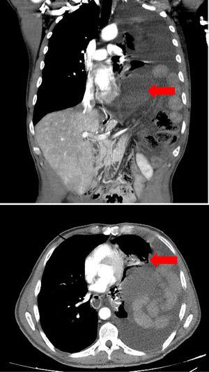 Coronal CT image showing ischemic colon and its relationship with the cardiac muscle. Axial CT image demonstrating left pulmonary atelectasis and cardiac compression (both marked with an arrow).