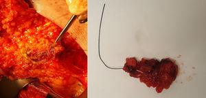 Biopsy of the clipped lymph node marked with a wire placed under ultrasound guidance; on the left, dissection of the lymph node targeted by the wire through a mastectomy incision; on the right, the surgical piece extracted and sent for pathology study using intraoperative One-Step Nucleic Acid Amplification (OSNA) analysis.