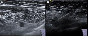 Image of interpectoral lymphadenopathy on ultrasound (a); Image of the ultrasound-guided placement of the magnetic seed (b).