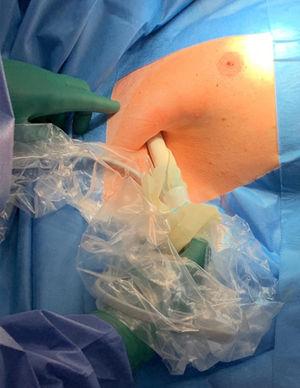Image of the surgical procedure using the Sentigag®/Sienna+® probe to locate the lesion.