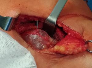 Intraoperative image of the cystic lesion (arrow) in the anterior cervical region, not adhered to adjacent structures.