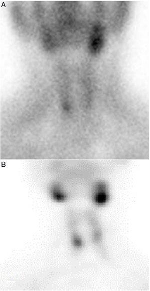 Scintigraphy of preoperative localization for the first surgery (A) and before the re-operation (B).