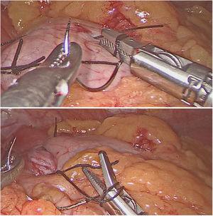 Intracorporeal knotting with FlexDex®.