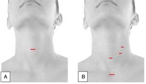 (A) Video-assisted surgical approach (MIVAT); (B) cervical approach with insufflation of CO2.
