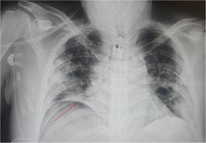 Follow-up chest X-ray after disconnection from mechanical ventilation; right subphrenic pneumoperitoneum is observed, as well as bilateral consolidations as a consequence of pneumonia due to COVID-19.