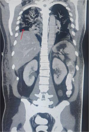 Coronal thoracoabdominal CT scan showing right subdiaphragmatic pneumoperitoneum (red arrow); contrast material in the descending colon, with no signs of leakage; extensive bilateral pneumonia due to COVID-19.