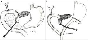 Post-PD reconstruction techniques with external Wirsung stenting: A) end-to-side duodenojejunostomy with pyloric preservation; B) end-to-side gastrojejunostomy and end-to-side jejunojejunostomy in Y in the antrectomy.