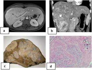 A) MRI of the liver: large, heterogeneous, polylobulated mass measuring 11.5 × 10 × 19 cm in segments IV, V, VI, VII and VIII with hypervascular uptake, with no clear washout in the portal and late phases, maintaining foci with no uptake at the central level, which coincided with the calcification on the CT scan; diffusion was slightly restricted; characteristics were compatible with fibrolamellar carcinoma; B) abdominal computed tomography: a large heterogeneous hepatic mass with irregular contour and heterogeneous density occupied segments IV, V, VI, VII and VIII, with multiple calcifications; irregular enhancement in arterial phase, and contrast washout in portal phase; C) macroscopic image: hepatectomy specimen measuring 24 × 17 × 19 cm and weighing 1500 g. It is almost entirely occupied by a 21 × 13 × 8 cm nodular whitish tumor that is in contact with the hepatic capsule and is away from the parenchymal resection margin; D) microscopic image with hematoxylin-eosin (10× magnification): proliferation of epithelioid and spindle-shaped cells with formation of osteoid; nests are observed with a central epithelial appearance, surrounded by spindle-shaped cells; calcified area.