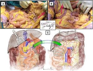 Longitudinal inframesocolic approach: (A and B) demonstration on a fresh cadaver. Red arrows indicate the direction of traction of the transverse colon, intestinal bundle, and sigmoid colon to achieve correct exposure of the infrarenal aorta. 1: duodenojejunal angle; 2: aorta. (C) The red dashed line indicates the release of the Treitz angle to achieve correct exposure. The anatomical structures exposed after opening the pre-aortic retroperitoneum are shown. 3: left renal vein; 4: inferior mesenteric artery. The color of the figure can only be seen in the electronic version.