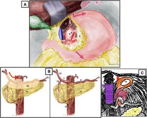 (A) Supraceliac approach. Red arrows mark the direction of esophagogastric traction. (B) Celiac trunk approach. Red arrow: direction of opening of the peritoneum that covers vascular structures. (C) Celiac trunk approach, identification of the arcuate ligament. 1: left triangular ligament of the liver; 2: lesser omentum or hepatogastric ligament; 3: caudate lobe of the liver; 4: gastroesophageal junction; 5: diaphragmatic crura; 6: celiac trunk; 7: common hepatic artery; 8: splenic artery; 9: left gastric artery; 10: peritoneum covering vascular structures; 11: pancreas; 12: gastroduodenal artery; 13: proper hepatic artery; 14: arcuate ligament; 15: esophageal hiatus; 16: vena cava; 17: superior mesenteric artery. The color of the figure can only be seen in the electronic version.