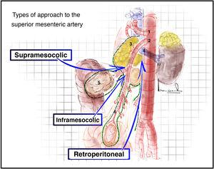 Types of approach to the superior mesenteric artery. Supramesocolic, inframesocolic and retroperitoneal. 1: superior mesenteric artery; 2: pancreas; 3: left renal vein; 4: duodenum; 5: transverse colon; 6: mesentery.