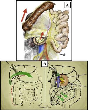 Cattell-Braasch maneuver. (A) Release of the colon and duodenum through the embryological plane of Toldt’s coalescence fascia. The red arrows indicate the direction of the traction of the right colon, duodenum and pancreas. (B) Release of the hepatic flexure first, followed by Kocher’s maneuver. The green arrows indicate the direction of traction of the hepatic flexure of the colon. The color of the figure can only be seen in the electronic version.