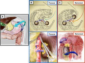 Mattox maneuver. (A) It begins with left decollation and splenic release from its adhesions to the parietal peritoneum. (B) Prerenal Mattox. (C) Retrorenal Mattox. 1: spleen; 2: stomach; 3: spleen; 4: left kidney; 5: left adrenal gland; 6: aorta; 7: celiac trunk; 8: superior mesenteric artery; 9: left renal artery; 10: inferior mesenteric artery; 11: left renal vein; 12: vena cava; 13: crura of the diaphragm; 14: splenic artery.