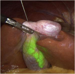 22G fine-needle injection of the gallbladder under direct vision.