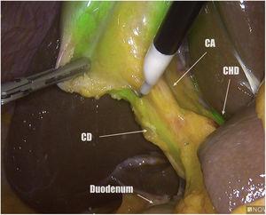 Anterior view of Calot’s triangle prior to its dissection and identification of the biliary structures. CA: cystic artery; CD: cystic duct; CHD: common hepatic duct.