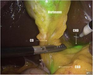 Identification of the CHD and common bile duct. CD: cystic duct; CHD: common hepatic duct.