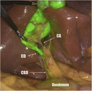 Critical view of safety. CA: cystic artery; CD: cystic duct.