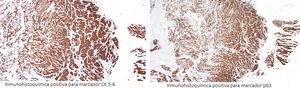 Immunohistochemistry of the surgical piece: A) Positive immunohistochemistry for CK 5-6; B) Positive immunohistochemistry for p63.
