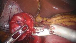 Excision of the tumor.
