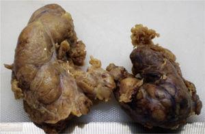 Surgical specimen from total thyroidectomy that shows enlargement of both thyroid lobes, which contain multiple nodules.
