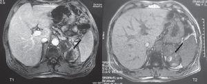 Abdominal MRI: bilobulated lesion, 8×6cm in diameter, with heterogeneous signal in T1 and T2 sequences, consistent with a left adrenal tumor, probably an adrenal carcinoma.