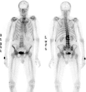 Bone lesions in scintigraphy.