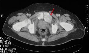 Lesión lítica expansiva correspondiente a osteítis fibrosa quística en una tomografía computarizada de la pelvis.