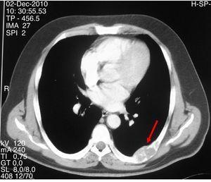 ＣＴでは，第七左肋弓に小葉の輪郭と皮質の薄化を伴う広大な溶解病変を示した。