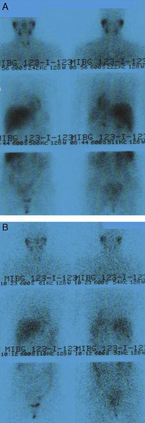123I-MIBG scintigraphy (dose of 185MBq). Anterior and posterior views of neck–chest–abdomen at 24h (A) and anterior and posterior views of neck–chest–abdomen at 48h (B). No pathological findings are seen. Images show a distribution of the radiopharmaceutical consistent with physiological distribution from the initial acquisitions.