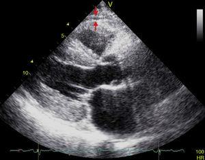 Echocardiographic measurement of epicardial adipose tissue thickness in the parasternal long axis. Epicardial fat is identified as the space (between arrows) between the outer myocardial wall and the visceral layer of the pericardium.