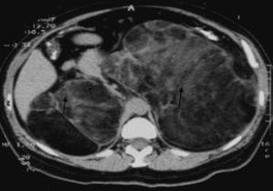 Giant tumors arising from the adrenal gland. Arrows point to tumors.