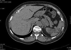 Cross section of computed tomography showing the left adrenal lesion, measuring >4cm and with an attenuation >10HUs. Both data suggest a malignant cause of adrenal incidentaloma, but this case is an important exception to this rule.